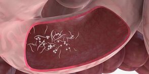 L'utilisation de triplets pour éliminer les parasites